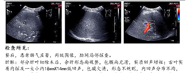 博鳌国际医院创造生命奇迹，晚期恶性黑色素瘤患者送旗感恩插图9
