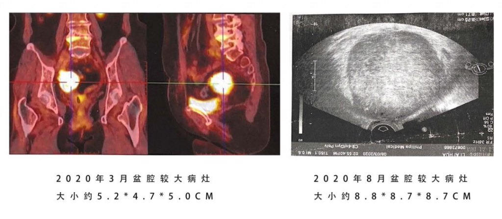 疑难肿瘤患者慕名求医 博鳌国际医院肿瘤专家精准施治插图